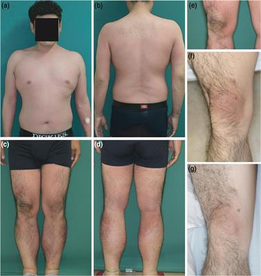 Case report: Severe non-pigmenting fixed drug eruption showing general symptoms caused by chondroitin sulfate sodium